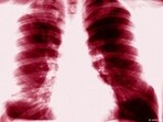 New insight into tuberculosis treatment: Research