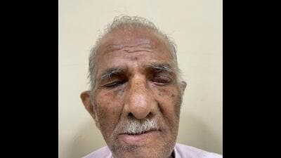 81-year-old undergoes gold eyelid implant 81-year-old undergoes gold eyelid implant