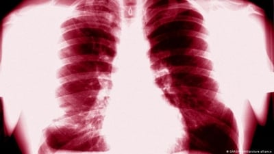 New insight into tuberculosis treatment: Research (GARO/PHANIE/picture alliance) New insight into tuberculosis treatment: Research (GARO/PHANIE/picture alliance)