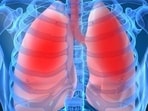Beyond smoking: Understanding and treating Chronic Obstructive Pulmonary Disease 