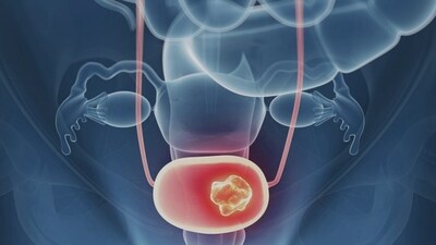 Why one type of chemotherapy works best in bladder cancer: Study reveals (Twitter/MedscapeCME) Why one type of chemotherapy works best in bladder cancer: Study reveals (Twitter/MedscapeCME)