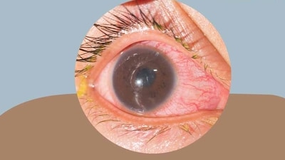 Iritis or inflammation of the iris: Causes, symptoms and care tips for your eyes (Photo by Twitter/homeopathy360) Iritis or inflammation of the iris: Causes, symptoms and care tips for your eyes (Photo by Twitter/homeopathy360)