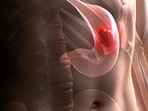 Urgent stomach cancer warning: Do not ignore these 5 common symptoms Urgent stomach cancer warning: Do not ignore these 5 common symptoms