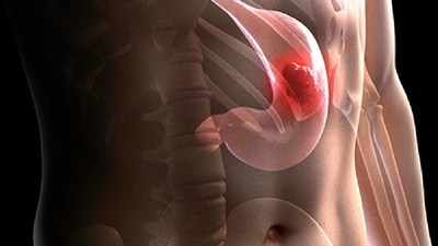 Urgent stomach cancer warning: Do not ignore these 5 common symptoms (Photo by Twitter/WebMD) Urgent stomach cancer warning: Do not ignore these 5 common symptoms (Photo by Twitter/WebMD)