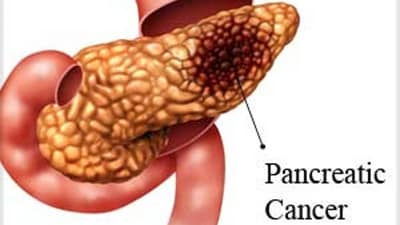 How to identify and manage the early signs of pancreatic cancer? (Photo by Yahoo) How to identify and manage the early signs of pancreatic cancer? (Photo by Yahoo)