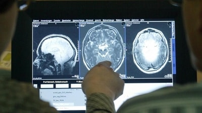 The exact role that amyloid-beta plays in Alzheimer’s is not fully understood. (Jens Wolf/dpa/picture-alliance) The exact role that amyloid-beta plays in Alzheimer’s is not fully understood. (Jens Wolf/dpa/picture-alliance)
