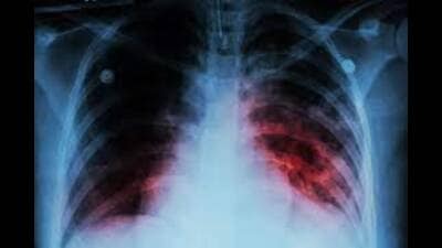 1,748 gram panchayats in UP claim to be TB-free (Pic for representation)