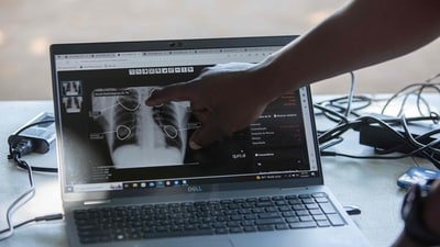 A medical practitioner shows the results of an X-ray medical test performed on a patient for TB. (Photo by Alfredo ZUNIGA / AFP) (AFP) A medical practitioner shows the results of an X-ray medical test performed on a patient for TB. (Photo by Alfredo ZUNIGA / AFP) (AFP)