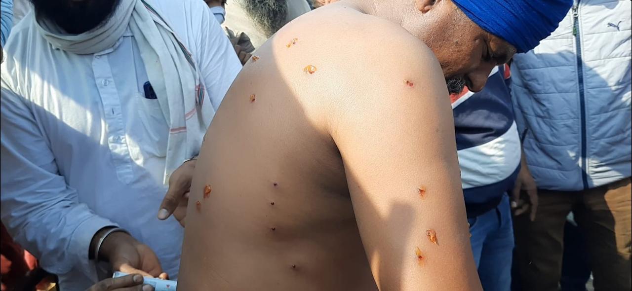 Punjab farmer got injured at Khanauri border (HT Photo/Sunil) Punjab farmer got injured at Khanauri border (HT Photo/Sunil)