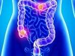 Colorectal cancer symptoms: What you need to know Colorectal cancer symptoms: What you need to know