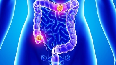 Colorectal cancer symptoms: What you need to know (Photo by Twitter/EvaSmartAI) Colorectal cancer symptoms: What you need to know (Photo by Twitter/EvaSmartAI)
