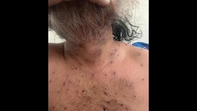 A farmer shows the pellet injuries on his chest, in Patiala. (HT Photo) A farmer shows the pellet injuries on his chest, in Patiala. (HT Photo)