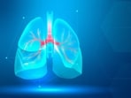 Popcorn lung, or bronchiolitis obliterans, is a rare lung disease that harms the small air sacs and passages in the lungs, known as bronchioles