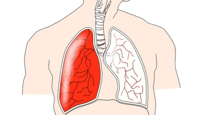 Air pollution linked to higher hospitalisations for heart, lung diseases: Study (Image by Clker-Free-Vector-Images from Pixabay ) Air pollution linked to higher hospitalisations for heart, lung diseases: Study (Image by Clker-Free-Vector-Images from Pixabay )