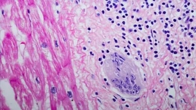 Sarcoidosis is a chronic inflammatory disease characterised by the formation of tiny lumps known as granulomas in the lungs and other organs. (Unsplash) Sarcoidosis is a chronic inflammatory disease characterised by the formation of tiny lumps known as granulomas in the lungs and other organs. (Unsplash)