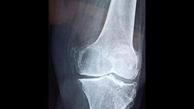 An associate professor from PGI Chandigarh department of orthopaedics received a patent for his skeleton traction patented. (HT File) An associate professor from PGI Chandigarh department of orthopaedics received a patent for his skeleton traction patented. (HT File)