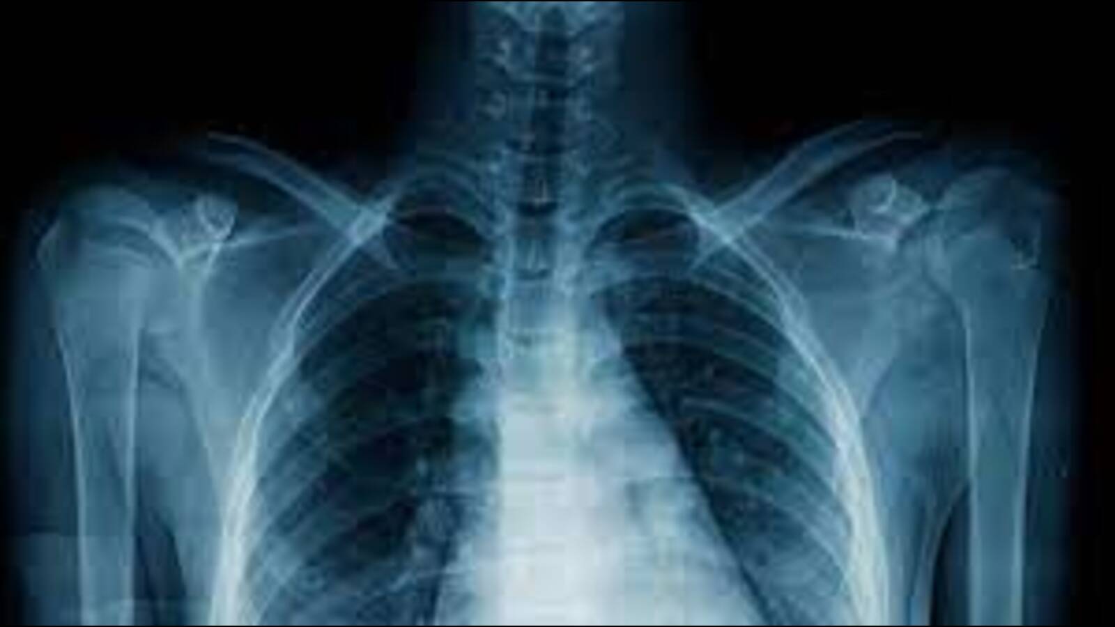 Cal Spot R Chest Not every spot detected on chest X-ray is TB: Expert | Hindustan Times