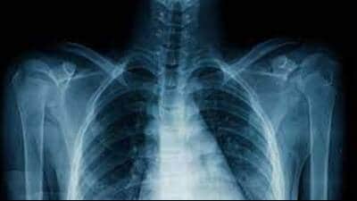 Not every spot detected on chest X-ray is TB: Expert (Pic for representation) Not every spot detected on chest X-ray is TB: Expert (Pic for representation)