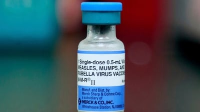 Mumps typically manifests as pain, tenderness, and swelling in one or both parotid salivary glands located in the cheek and jaw area. (Representational Image) (AP) Mumps typically manifests as pain, tenderness, and swelling in one or both parotid salivary glands located in the cheek and jaw area. (Representational Image) (AP)