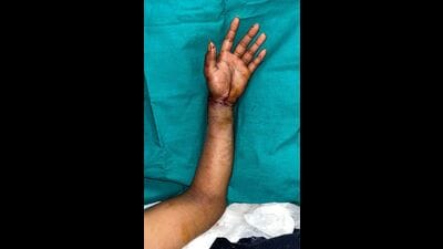 The reattached hand after the surgery. (Sourced) The reattached hand after the surgery. (Sourced)