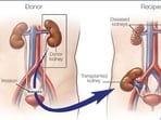 Miracles of kidney transplant: Benefits, procedure, everything to know for those suffering from end-stage renal disease 