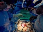 US doctors have transplanted world's first genetically-engineered pig kidney into a 62-year-old patient. US doctors have transplanted world's first genetically-engineered pig kidney into a 62-year-old patient.