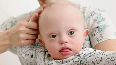 Genetic Condition: Down syndrome is a genetic condition caused by the presence of an extra copy of chromosome 21. This additional genetic material affects the development of a person, leading to distinct physical and cognitive characteristics. (Pexels) Genetic Condition: Down syndrome is a genetic condition caused by the presence of an extra copy of chromosome 21. This additional genetic material affects the development of a person, leading to distinct physical and cognitive characteristics. (Pexels)