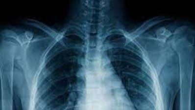 World Tuberculosis (TB) Day 2024: All you want to know about date, history, theme and significance World Tuberculosis (TB) Day 2024: All you want to know about date, history, theme and significance