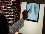 Awareness and early treatment are even more vital given that women and girls make up nearly one million of the estimated 2.8 million TB cases in India each year  (HT PHOTO)