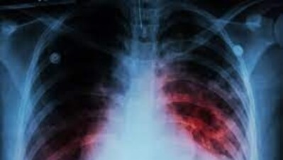 The overall notification of TB cases has improved by 64% over the last nine years. (Representational Image)