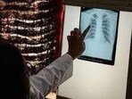 Non-lung TB is another challenging facet of India’s TB burden. (HT PHOTO)