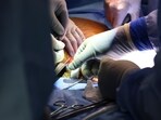 Surgeons perform the world’s first genetically modified pig kidney transplant into a living human at Massachusetts General Hospital, Saturday, March 16, 2024, in Boston, Mass. (Massachusetts General Hospital via AP)