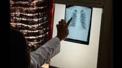 Non-lung TB is another challenging facet of India’s TB burden.  (HT PHOTO)