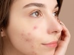 pimple