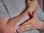 Systemic Lupus Erythematosus: Advice for caregivers and SLE patients to lead a ‘near normal’ life 
