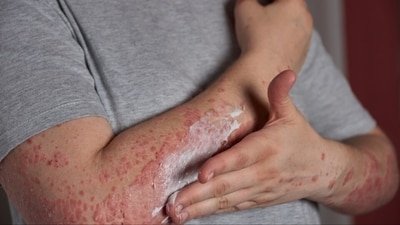 Systemic Lupus Erythematosus: Advice for caregivers and SLE patients to lead a ‘near normal’ life (Image by wirestock on Freepik) Systemic Lupus Erythematosus: Advice for caregivers and SLE patients to lead a ‘near normal’ life (Image by wirestock on Freepik)