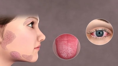 Sjögren’s Syndrome: Causes, symptoms, diagnosis and treatment of this autoimmune disease (Photo by YouMeMindBody) Sjögren’s Syndrome: Causes, symptoms, diagnosis and treatment of this autoimmune disease (Photo by YouMeMindBody)