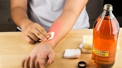 10. Easy bruising: Increased tendency to bruise or bleed easily can be due to liver impairment. (Shutterstock) 10. Easy bruising: Increased tendency to bruise or bleed easily can be due to liver impairment. (Shutterstock)