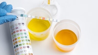 7. Dark urine: Urine appearing darker than usual signals potential liver issues. (Freepik) 7. Dark urine: Urine appearing darker than usual signals potential liver issues. (Freepik)