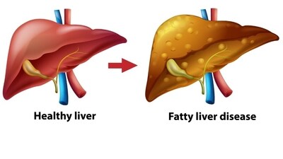 Steatotic liver disease: Symptoms, risk factors and prevention of non-alcoholic fatty liver disease (Image by brgfx on Freepik) Steatotic liver disease: Symptoms, risk factors and prevention of non-alcoholic fatty liver disease (Image by brgfx on Freepik)