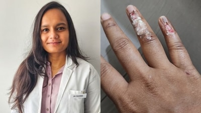 Dr Ruchika shared this picture of her injured hand after the Uber cab
met with an accident. (X/@theindiangirl__/photo) Dr Ruchika shared this picture of her injured hand after the Uber cab
met with an accident. (X/@theindiangirl__/photo)