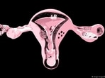 PCOS is a condition where the ovaries produce an abnormal amount of Androgen leading to cyst formation in the ovaries. Menstrual irregularities, obesity, acne formation and mood swings follow. High Testosterone levels with PCOS can be treated naturally with a few dietary and lifestyle changes. "You may notice that after changing some lifestyle habits to target one aspect of PCOS (such as testosterone levels) you see improvements in another symptom as well," wrote Dietitian Tallene Hacatoryan.