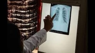 Host-directed therapies employ the body's immune system to target TB. (HT PHOTO) Host-directed therapies employ the body's immune system to target TB. (HT PHOTO)