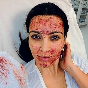 Kim Kardashian posted this photo of herself getting a Vampire Facial, Celebs like Kardashian have popularised this facial, which can cost between ₹15,000- ₹30,000 in India, depending on factors such as consultation charges, number of sessions, etc. (Instagram ) Kim Kardashian posted this photo of herself getting a Vampire Facial, Celebs like Kardashian have popularised this facial, which can cost between ₹15,000- ₹30,000 in India, depending on factors such as consultation charges, number of sessions, etc. (Instagram )