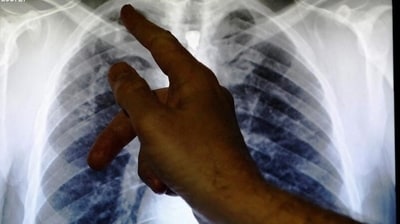 Tuberculosis can cause severe damage to the lungs, leaving patients with health issues, such as shortness of breath, for years after the infection is cured (Luke MacGregor/REUTERS ) Tuberculosis can cause severe damage to the lungs, leaving patients with health issues, such as shortness of breath, for years after the infection is cured (Luke MacGregor/REUTERS )