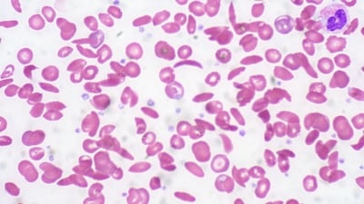 According to the New York Times, Kendric's successful therapy provides hope to around 20,000 people in the United States who suffer from sickle cell disease. According to the New York Times, Kendric's successful therapy provides hope to around 20,000 people in the United States who suffer from sickle cell disease.