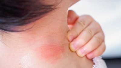 Cortisol can induce changes in nerve function – this can lead to symptoms of tingling or itching on the skin. (Pinterest) Cortisol can induce changes in nerve function – this can lead to symptoms of tingling or itching on the skin. (Pinterest)