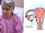 Endometriosis is a condition where tissue similar to the lining inside the uterus (called the endometrium) starts to grow outside the uterus. Endometriosis is a condition where tissue similar to the lining inside the uterus (called the endometrium) starts to grow outside the uterus.