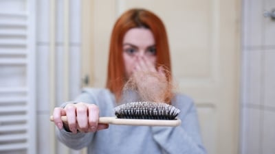 Androgenic Alopecia, also known as female pattern baldness, is influenced by the high amount of Androgen, such as Testosterone, produced by the ovaries. (Pixabay) Androgenic Alopecia, also known as female pattern baldness, is influenced by the high amount of Androgen, such as Testosterone, produced by the ovaries. (Pixabay)