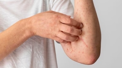 Use Mosquito Repellents: Apply mosquito repellents containing active ingredients like DEET, picaridin, or IR3535 when going outdoors, especially during peak mosquito activity hours. (Freepik) Use Mosquito Repellents: Apply mosquito repellents containing active ingredients like DEET, picaridin, or IR3535 when going outdoors, especially during peak mosquito activity hours. (Freepik)